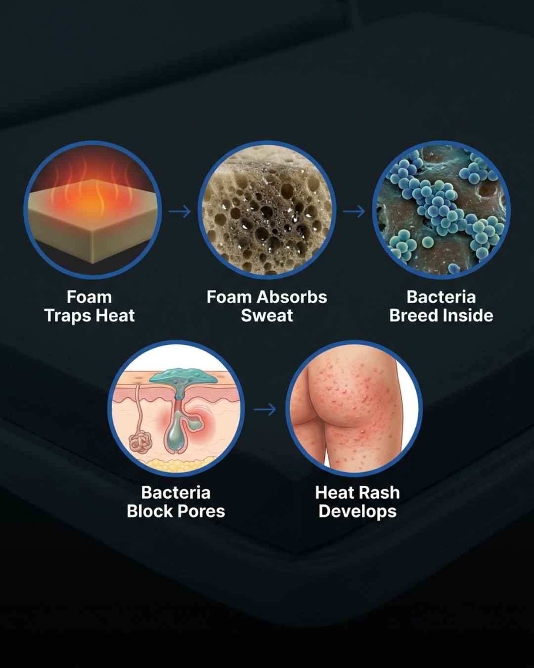 The five causes of heat rash: trapped heat, absorbed sweat, bacteria breeding, blocked pores, heat rash